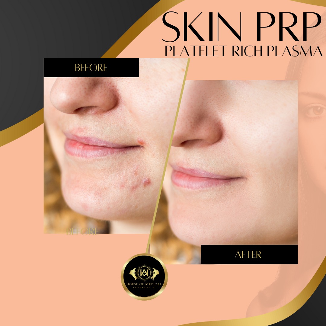 Platelet Rich Plasma (PRP)... - House of Medical Aesthetics | Facebook