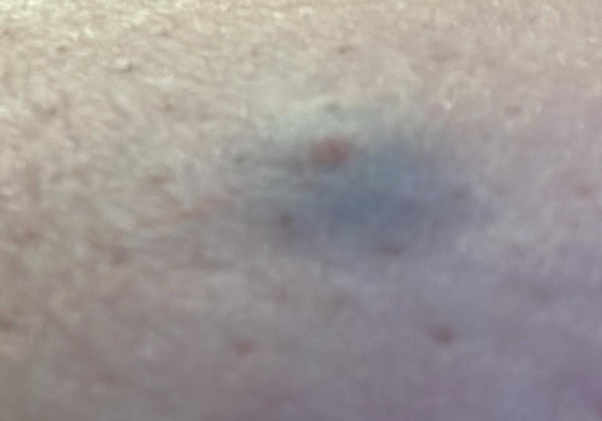 tirzepatide shot bruise Does anyone else have a problem with bruising after injections? : r/tirzepatidecompound bruise at tirzepatide injection site
