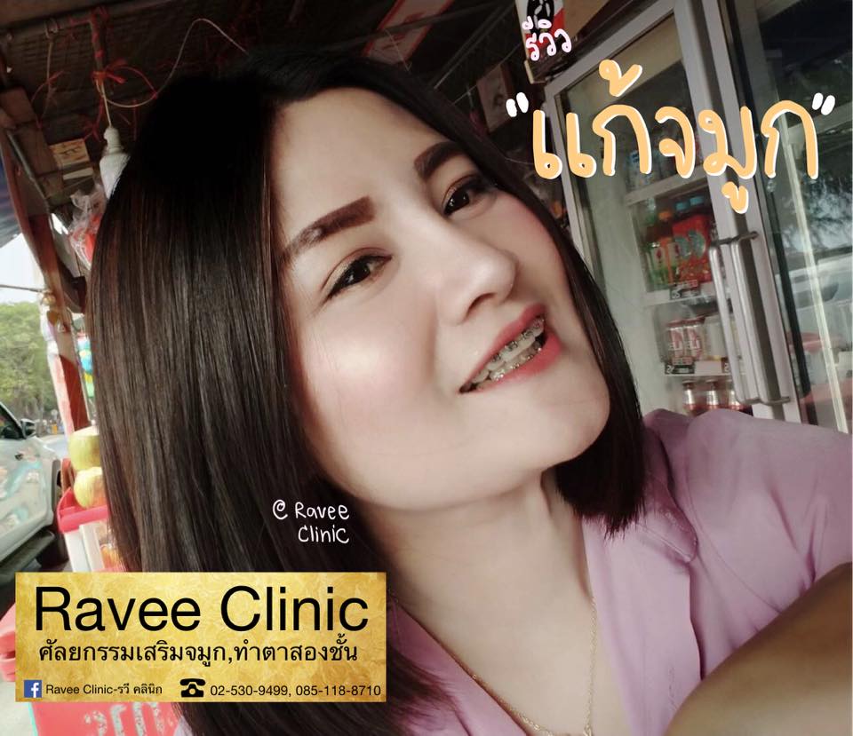 ‼️เปลี่ยนจมูก 