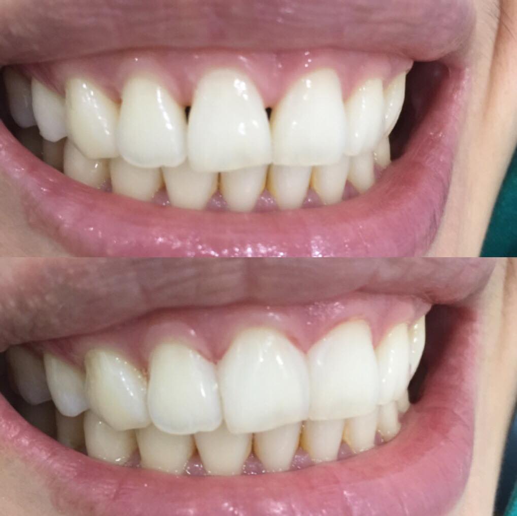Black triangle Gap closure We... - DR.MOD Dental Clinic