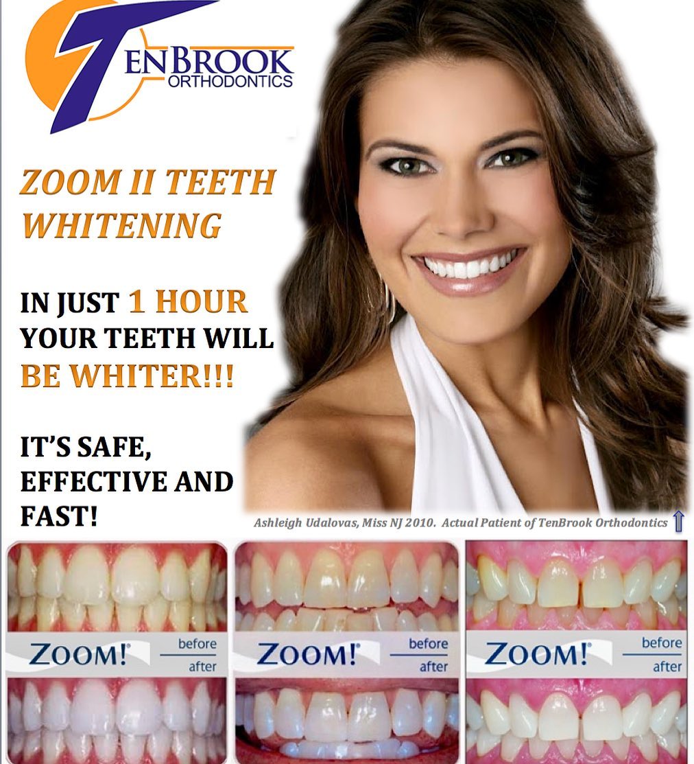 TenBrook Orthodontics - 🦷 White Teeth Wednesday! 🙌🏻 𝗗𝗼 𝘆𝗼𝘂 𝘄𝗮𝗻𝘁 𝘄𝗵𝗶𝘁𝗲𝗿 ...