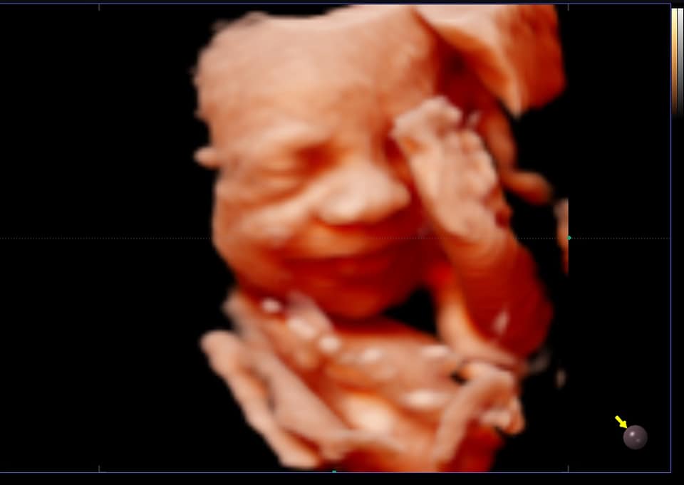 Echographie 3d Bebe Art Echo Facebook