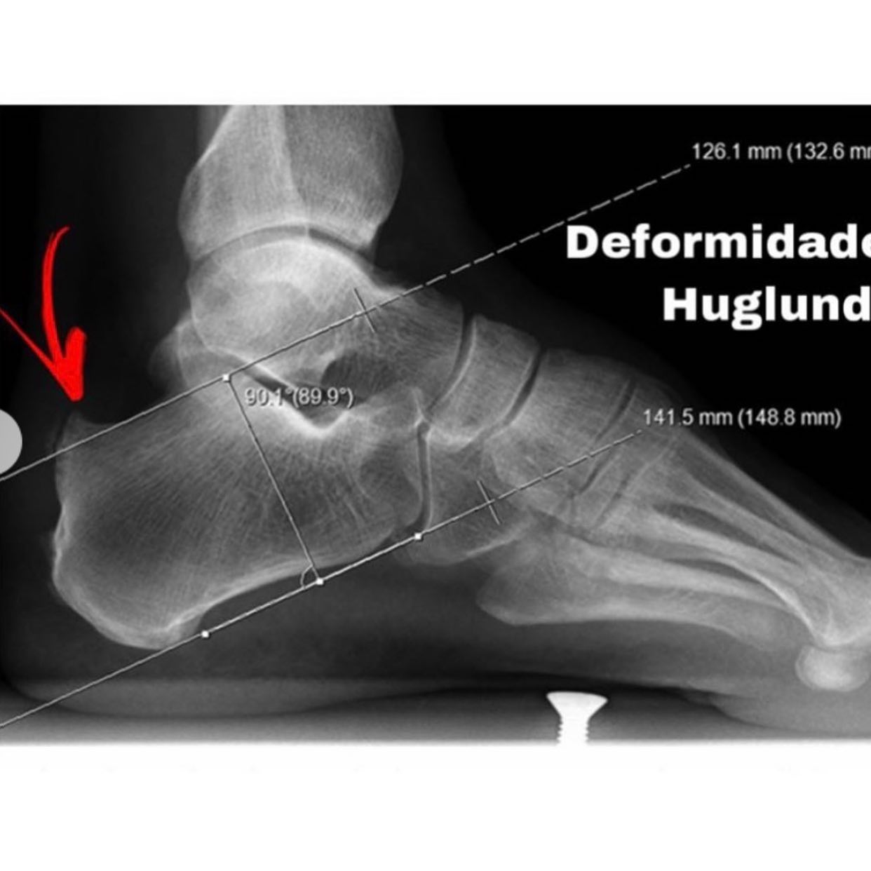 *Síndrome de Haglund... - Reumatologia - Clinica ReumaDor | Facebook