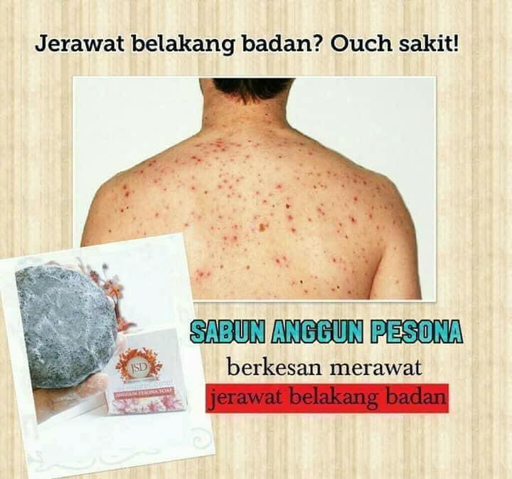 Jsd Sarawak Tak Selesa Kan Kalau Ada Jerawat Kat Belakang Badan Antara Sebab Jerawat Belakang Badan 1 Keturunan 2 Penggunaan Pil Perancang Ubat Steroid Dan Vitamin B12 3 Produk Yang Tidak