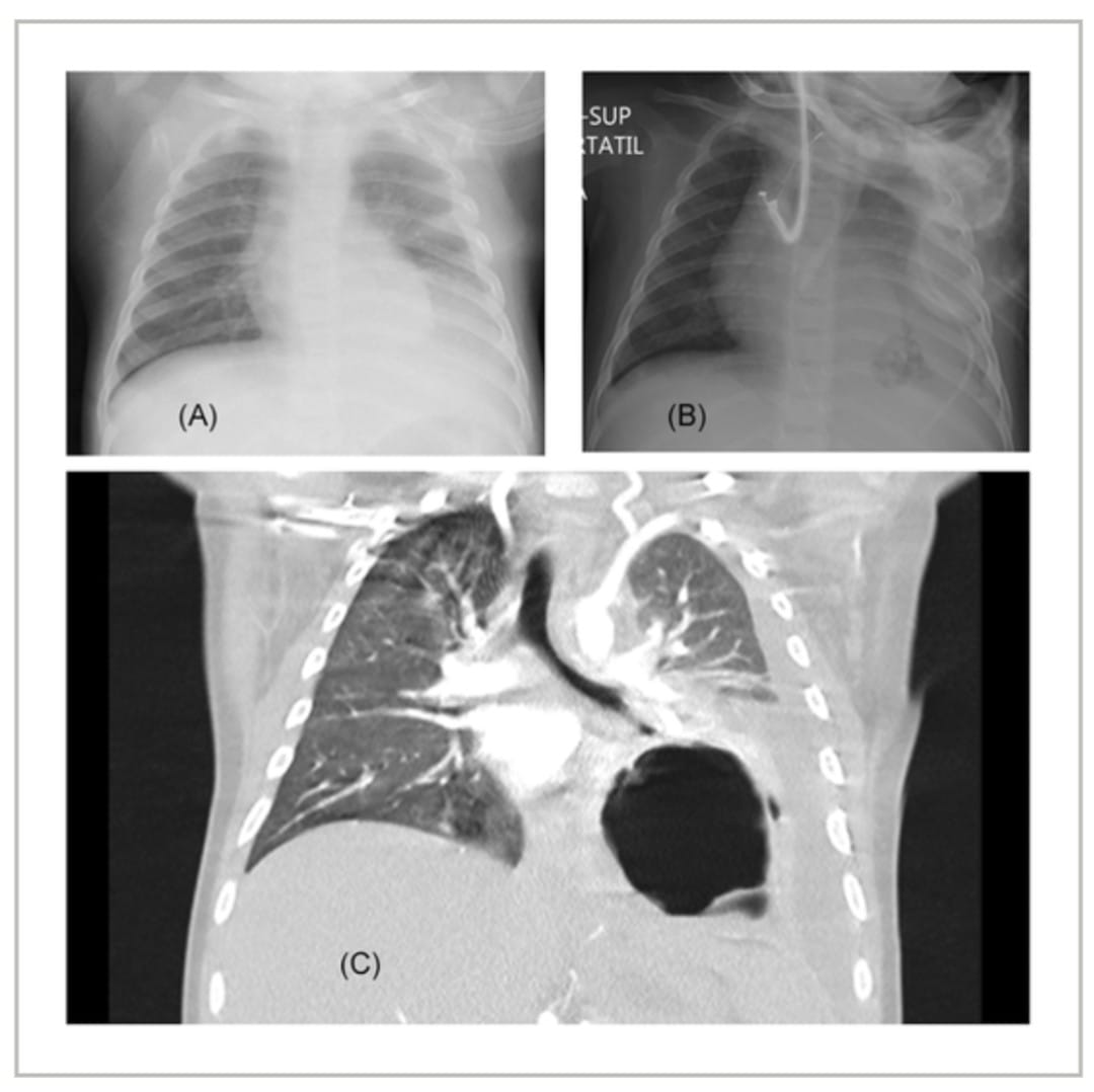 GEUP - 📌 La coinfección por SARS-CoV-2 y Streptococcus pneumoniae como ...