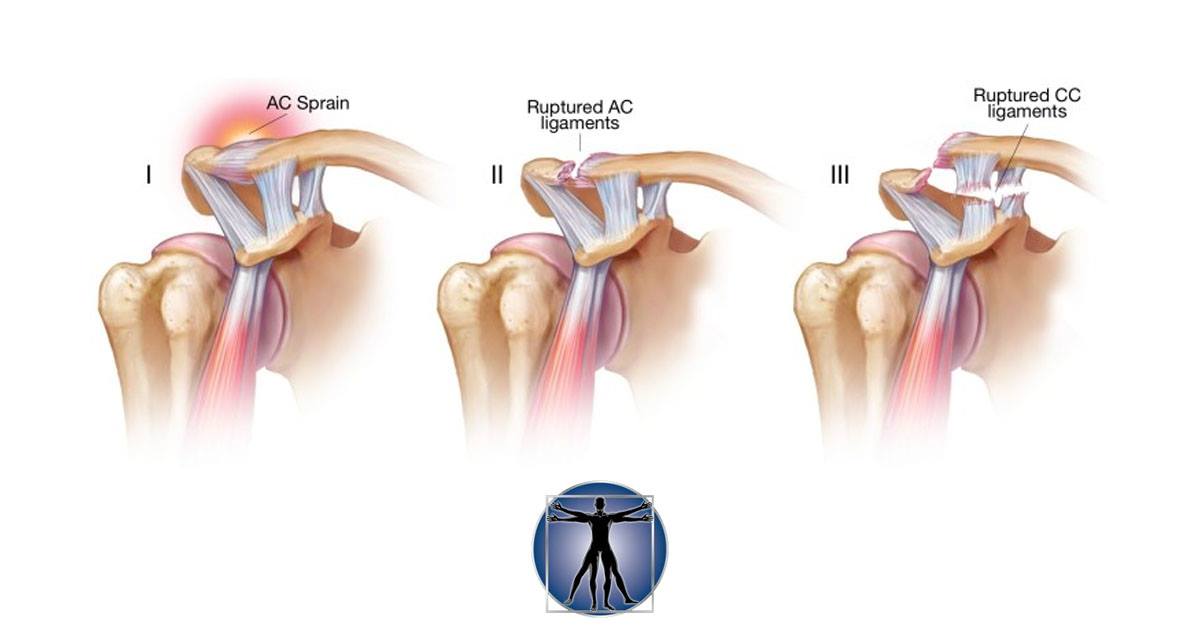 Burquitlam - What is an AC Joint Injury? (also known as ...