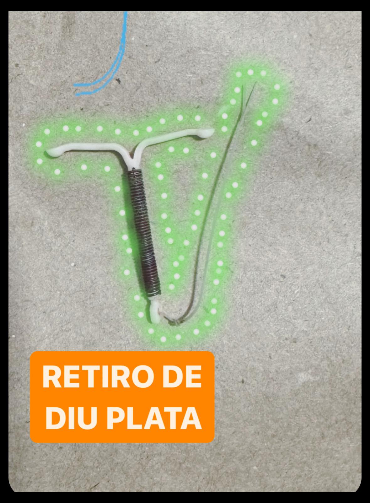 ⚡️Retiro de DIU... Se... - Dra. Adriana K. Hernández Mendoza | Facebook