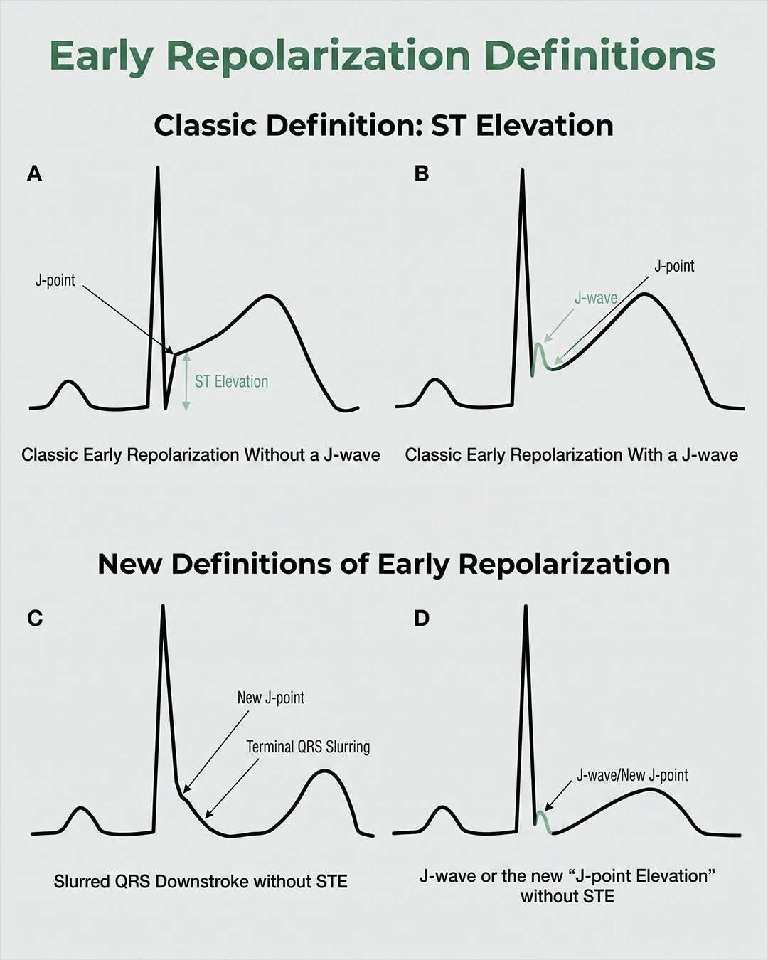 The J Wave (Osborn Wave): J wave, an extra deflection at the QRS