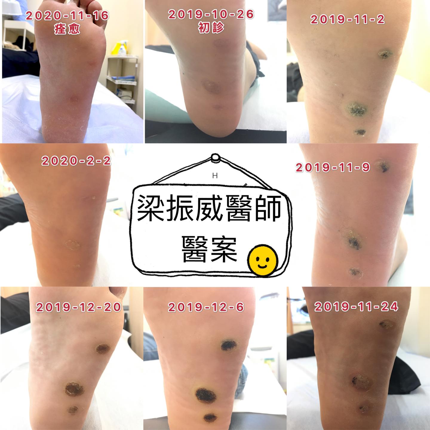 易健中醫診所 - 火針治疣個案🔥🦯...