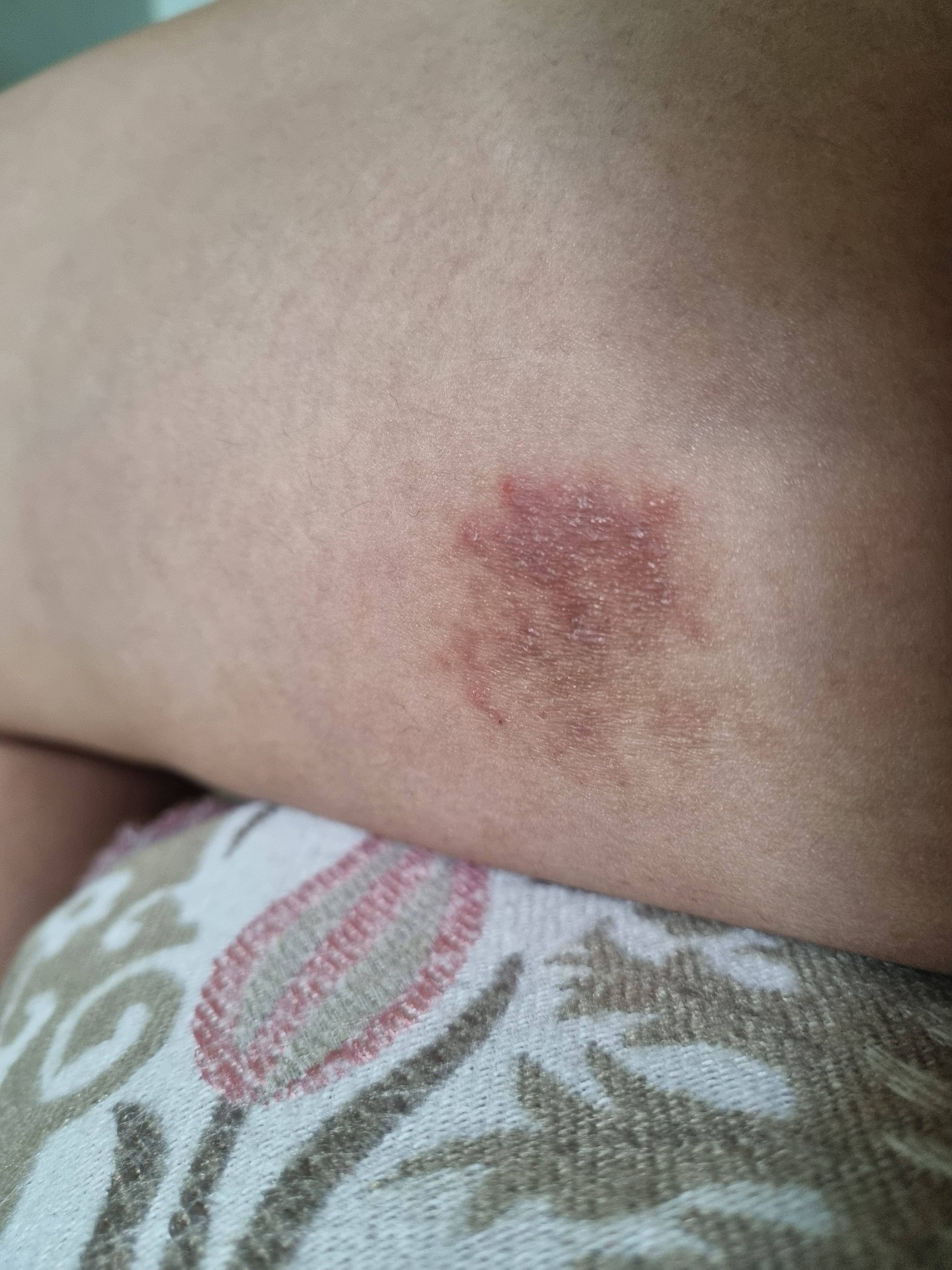 Anyone else here on tirzepatide? Ever since I have been taking it and losing weight along with going to the gym 5 days a week, my hands have been completely clear despite