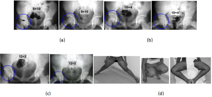 Symbiosis - Valgus Slipped Capital Femoral Epiphysis (SCFE) Managed by ...