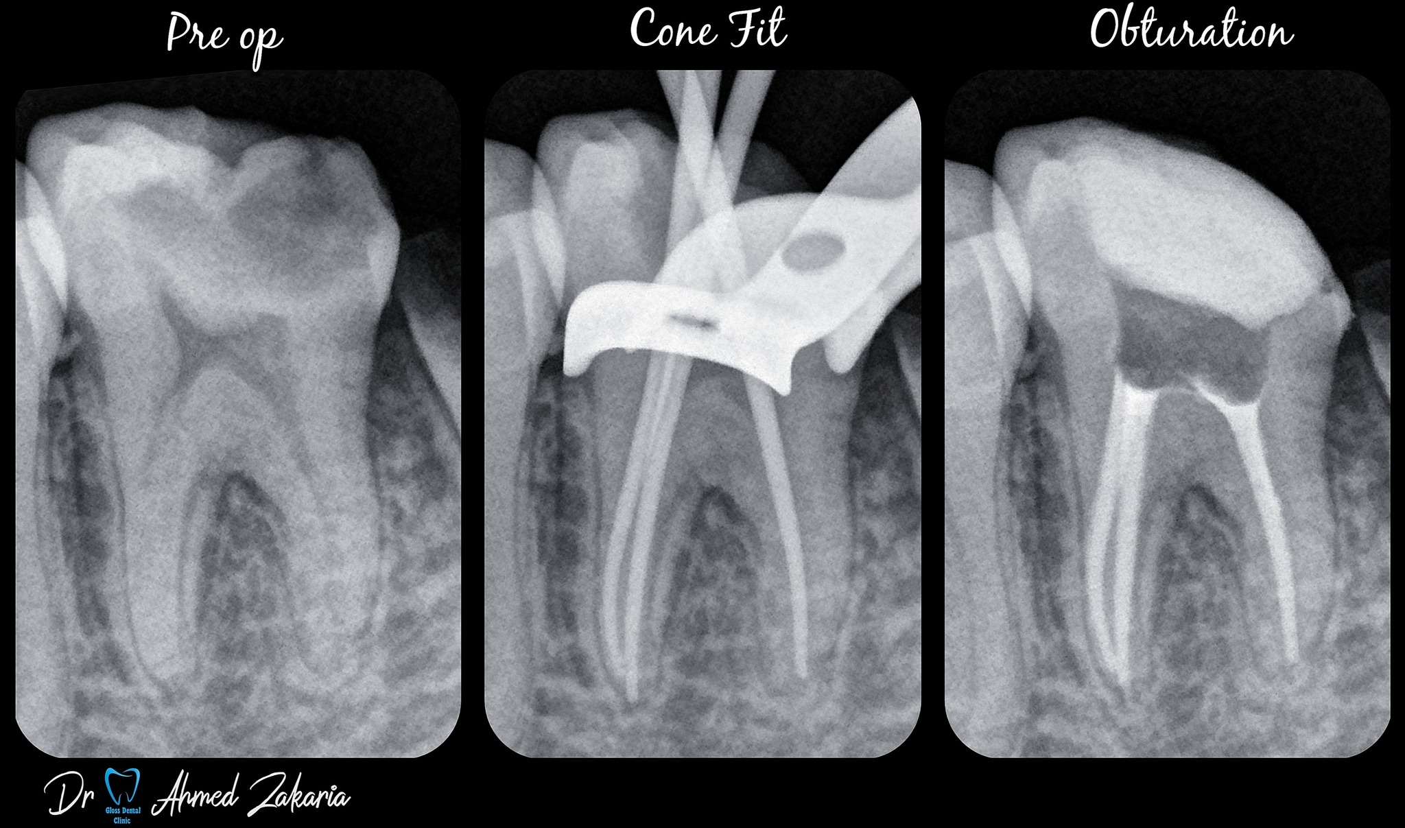Style Italiano Endodontics | RCT for Lower Molar 💯 | Facebook