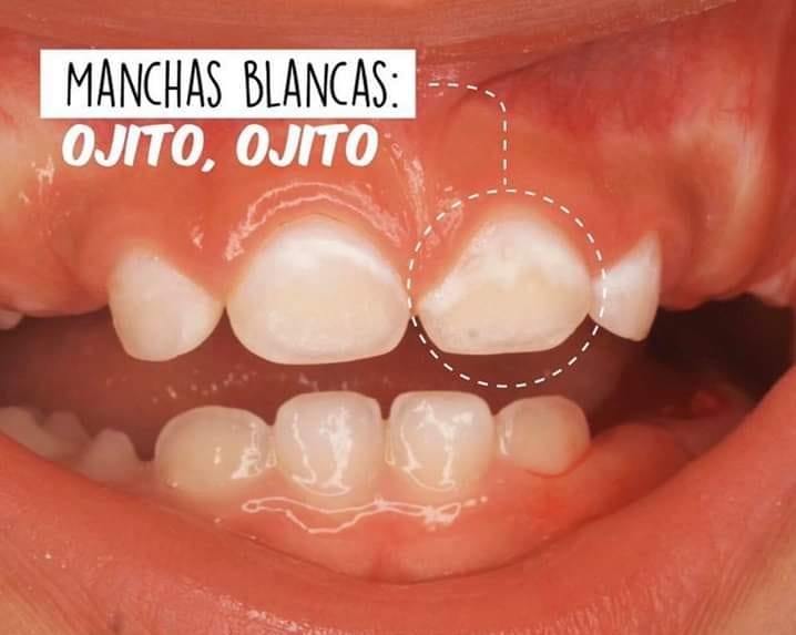 BioDental - ⁉️ ¿Qué son las manchas blancas en lo dientes...