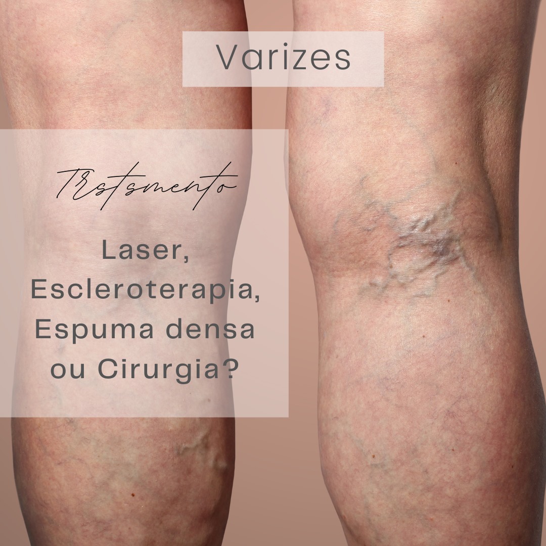 🦵 O tratamento de varizes e... - Invasc - Instituto Vascular