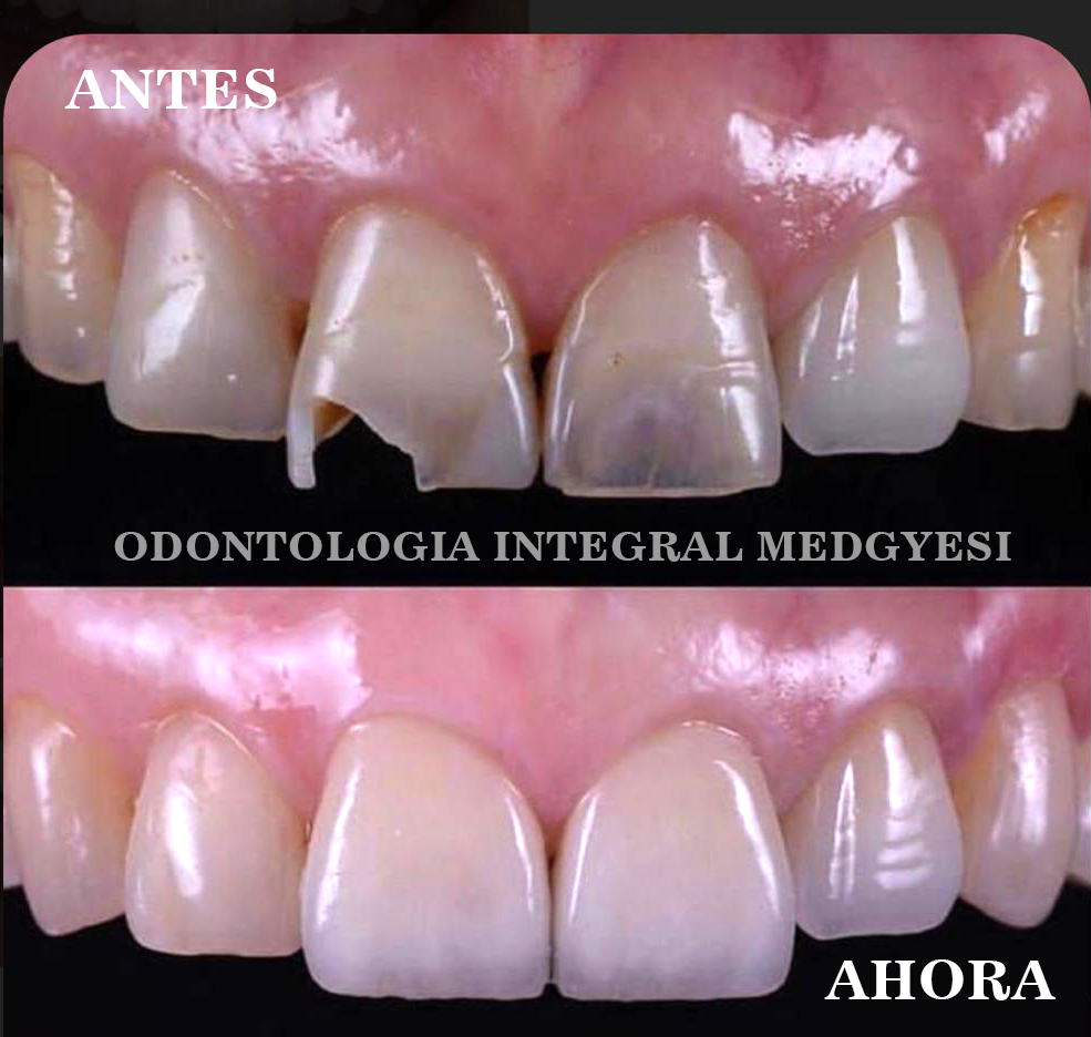 Odontologia Integral Medgyesi - Rehabilitación Oral en paciente con # ...