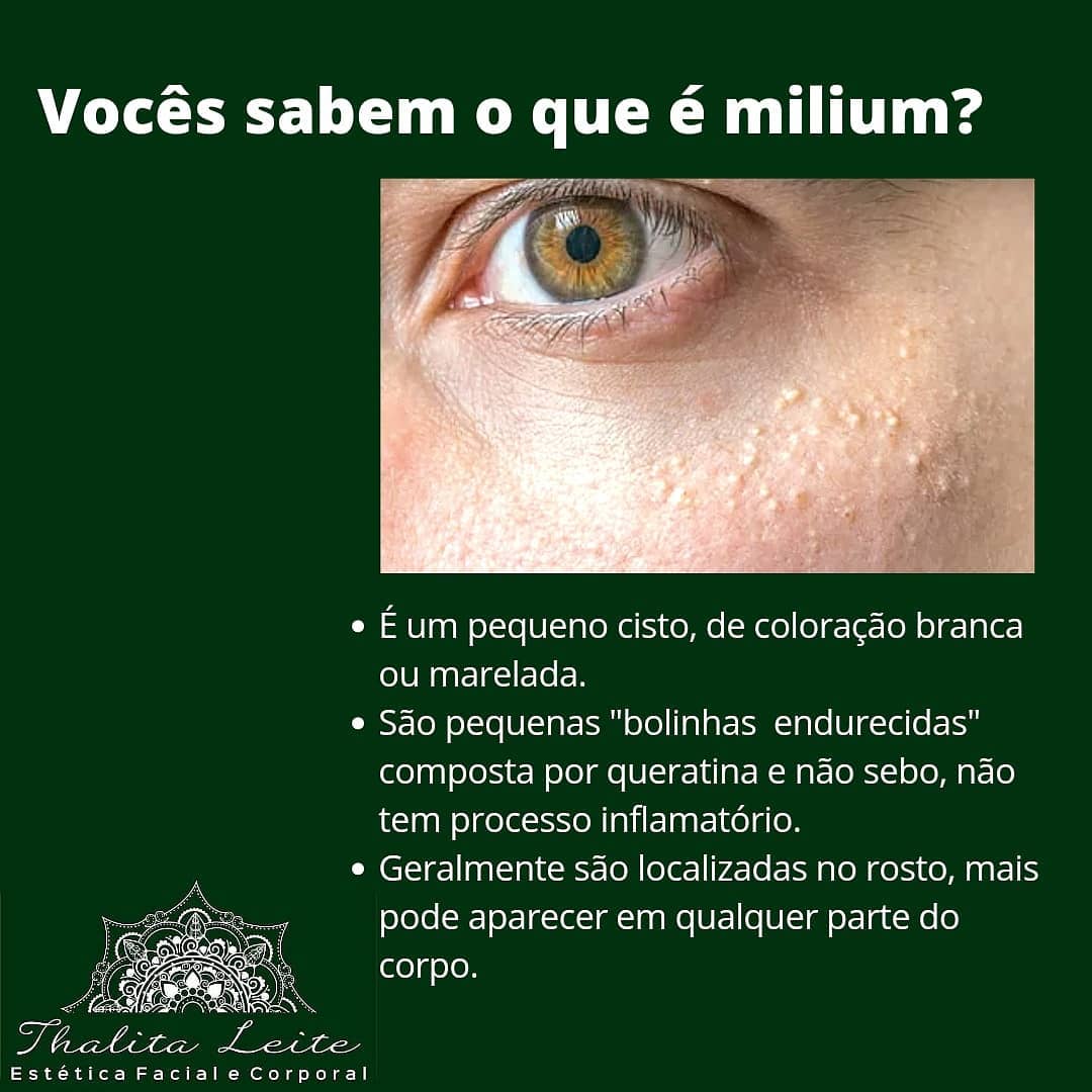 O tratamento para extrair os milium... - Spa Thalita Leite