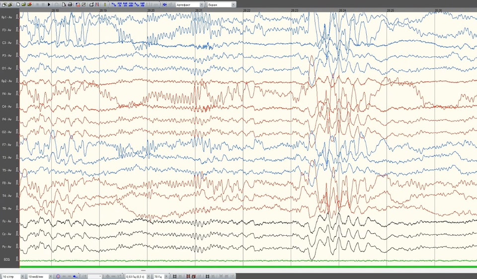 eeg 2011年 5 years child Both 14- and 6-Hz positive spikes are observed