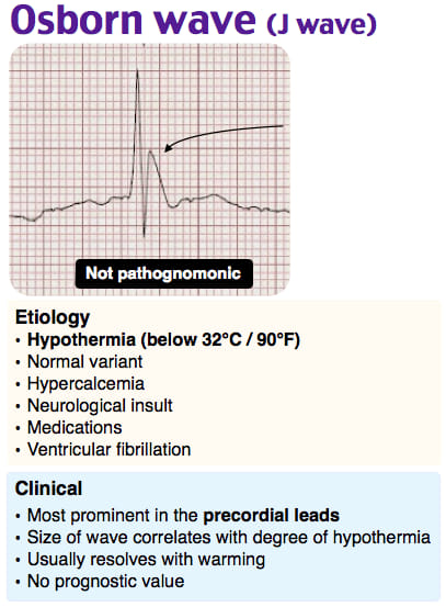 The J Wave (Osborn Wave): J wave, an extra deflection at the QRS