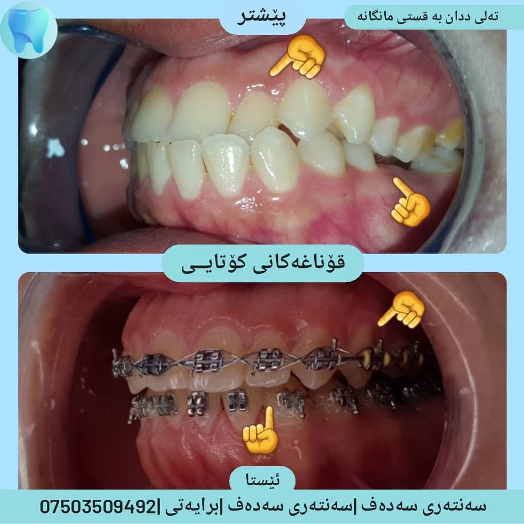 پزیشکی ددان - قۆناغەکانی کۆتایی ڕێک بوونەوەی ددانەکانی... | Facebook