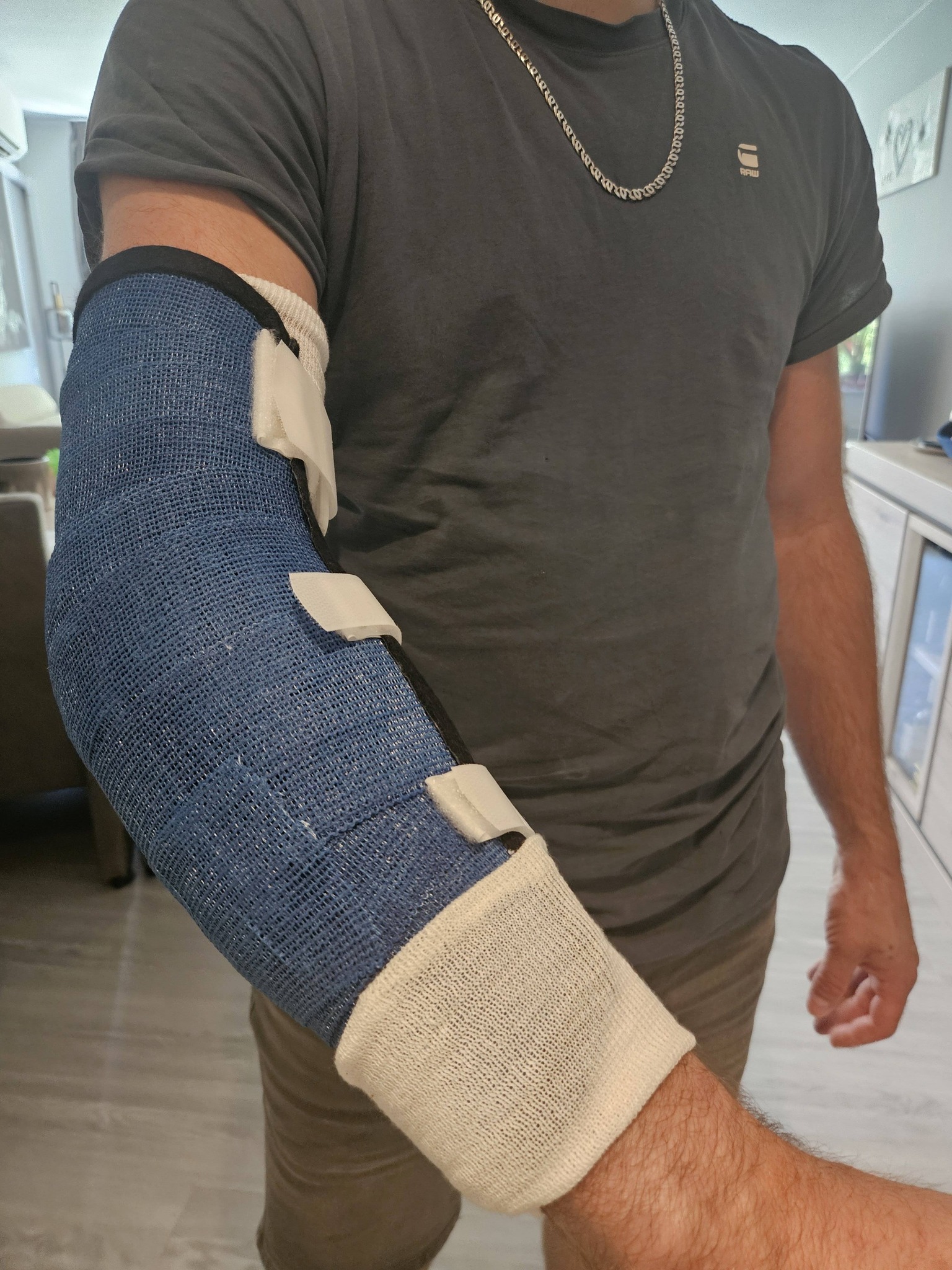 Recovery from distal biceps tendon surgery with BPC-157/TB-500