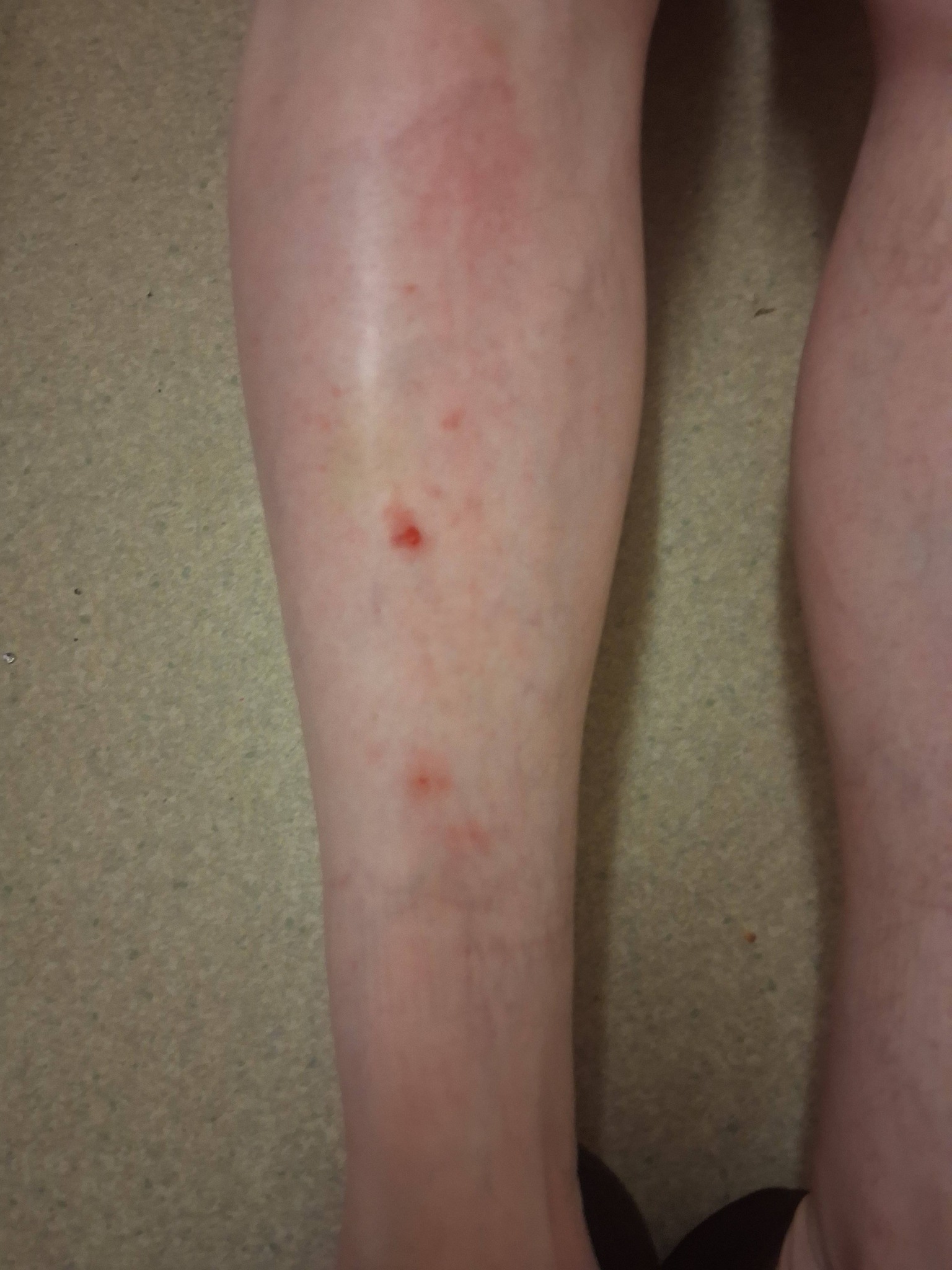 Anyone else have this rash on there legs???