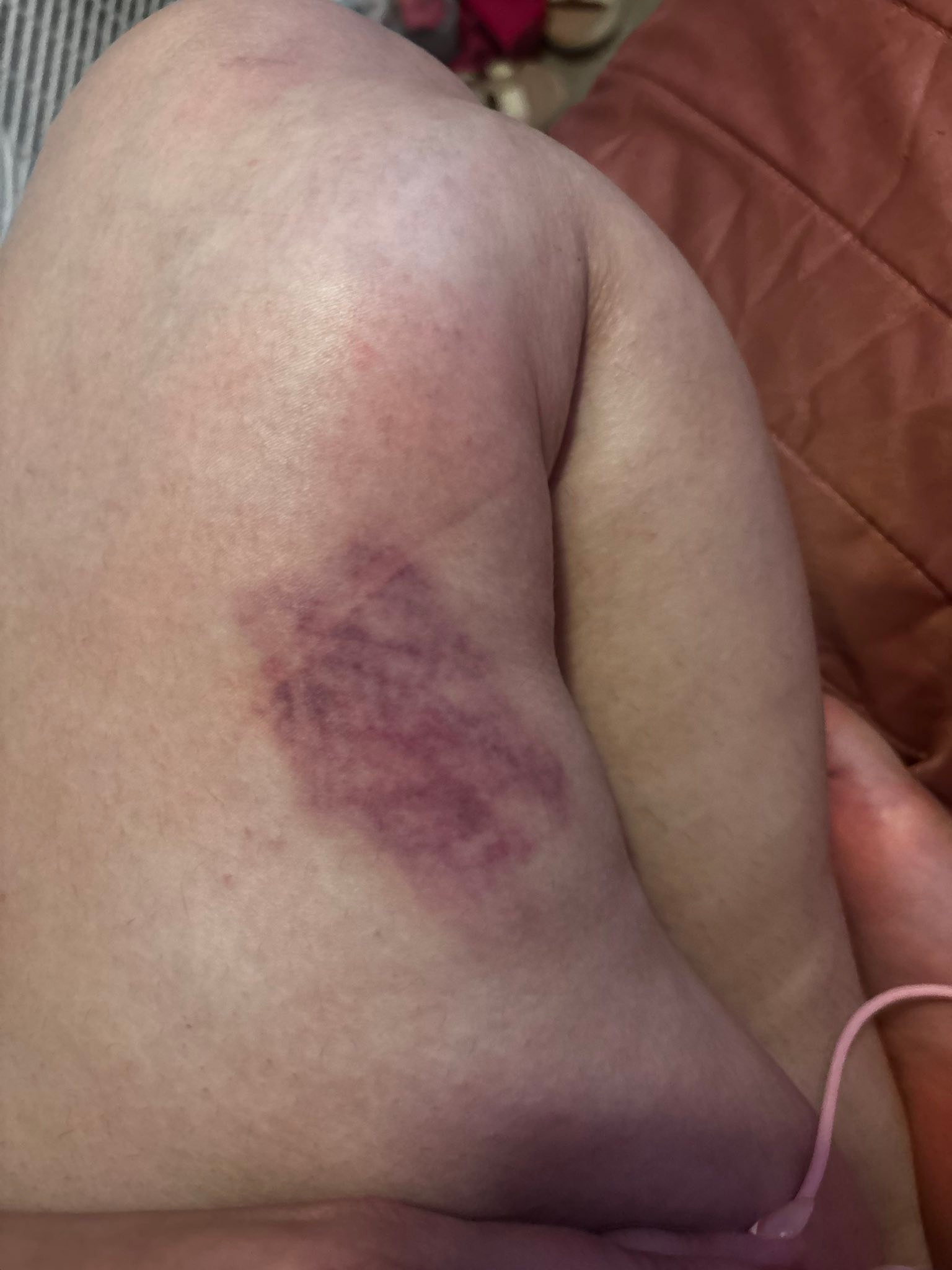 l carnitine skin rash Do people commonly bruise easily on their legs from scratching? Medicube Skin Repair Cream Flavor:Orange Pulp Vitamin B12 Injections in