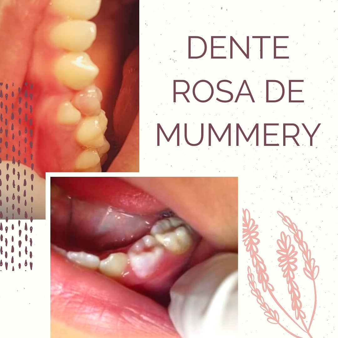 Dra. Elisa de Oliveira Schmeling - O dente está rosa e agora? 🦷 Essa ...