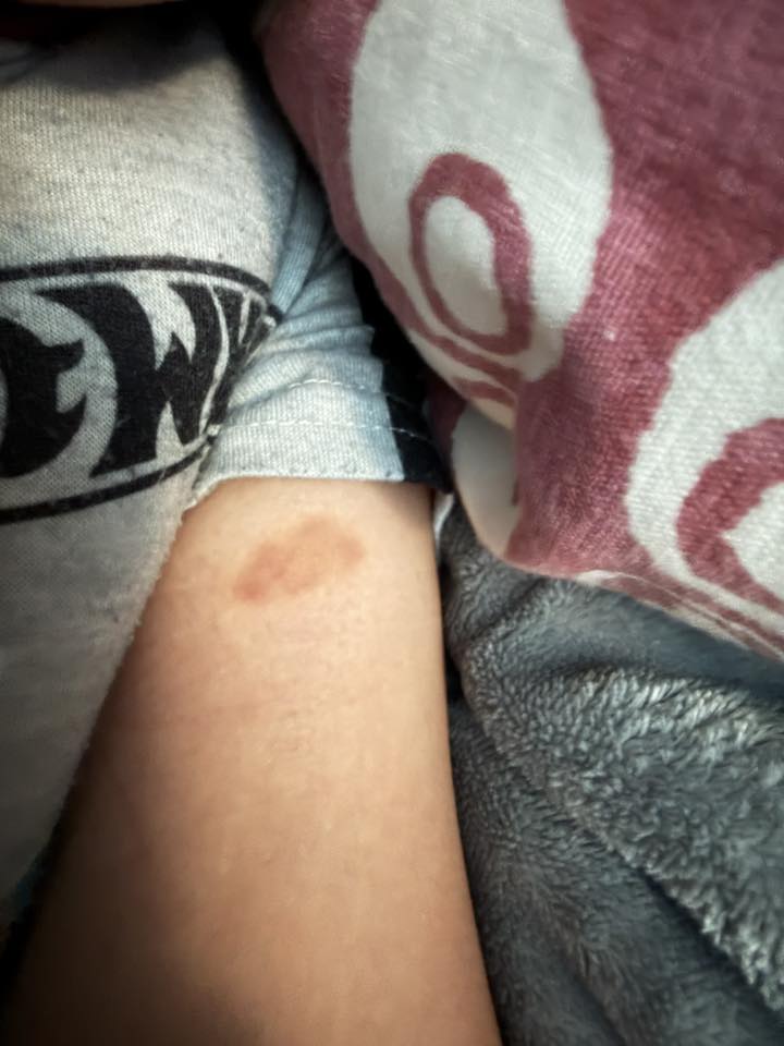 What causes unexplained bruises on a 4-year-old autistic child?