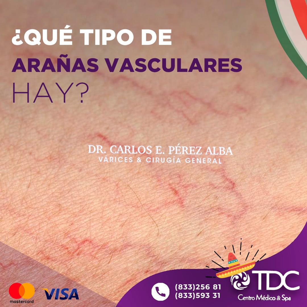 Dr.Carlos - Las arañas vasculares son un entramado de vasos capilares ...