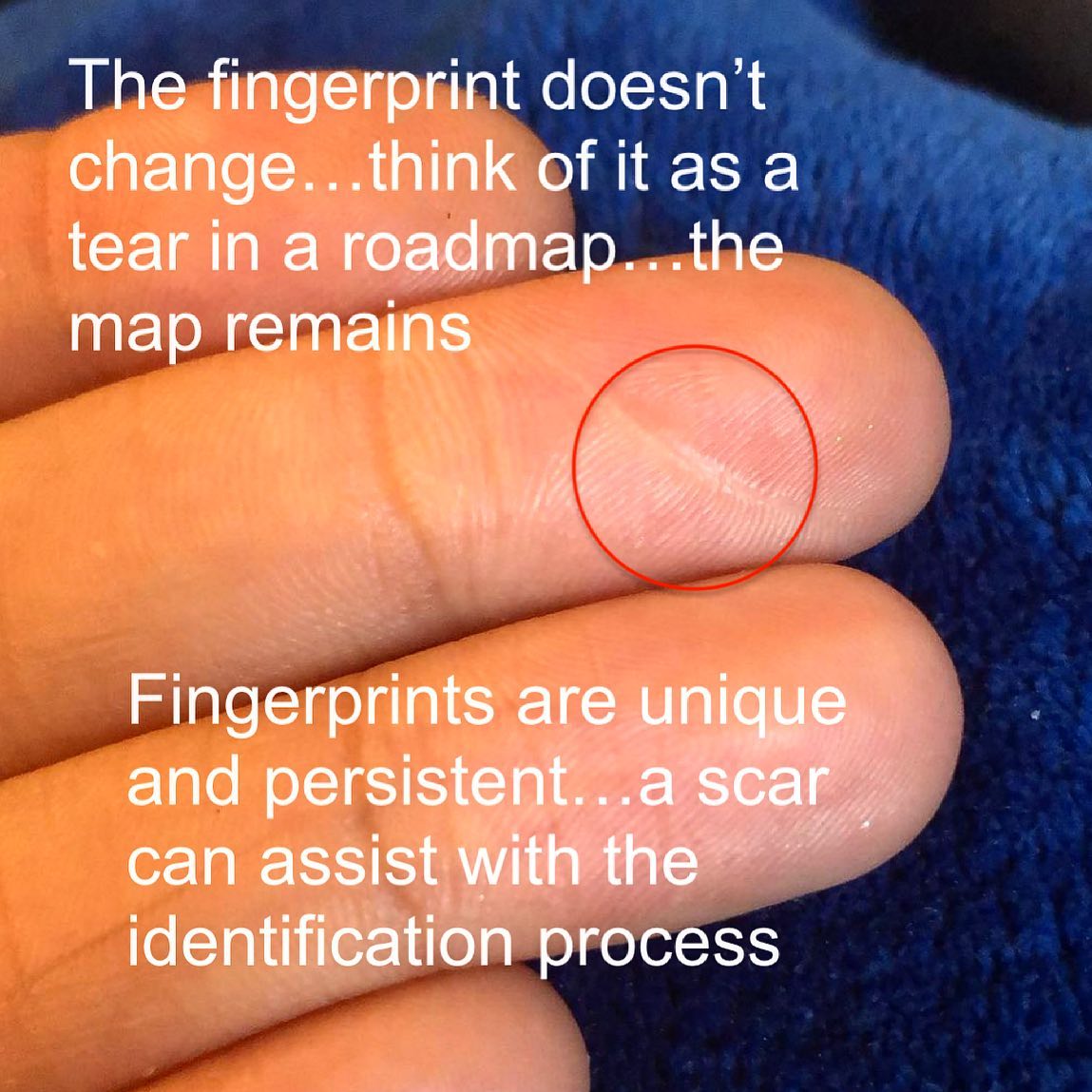 forensicsworld - SCAR When damage to friction ridge skin...