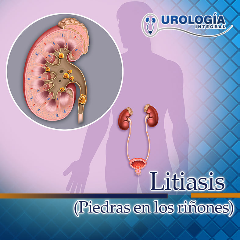 ¿Sientes dolor en los riñones o dolor... - Urología Integral | Facebook