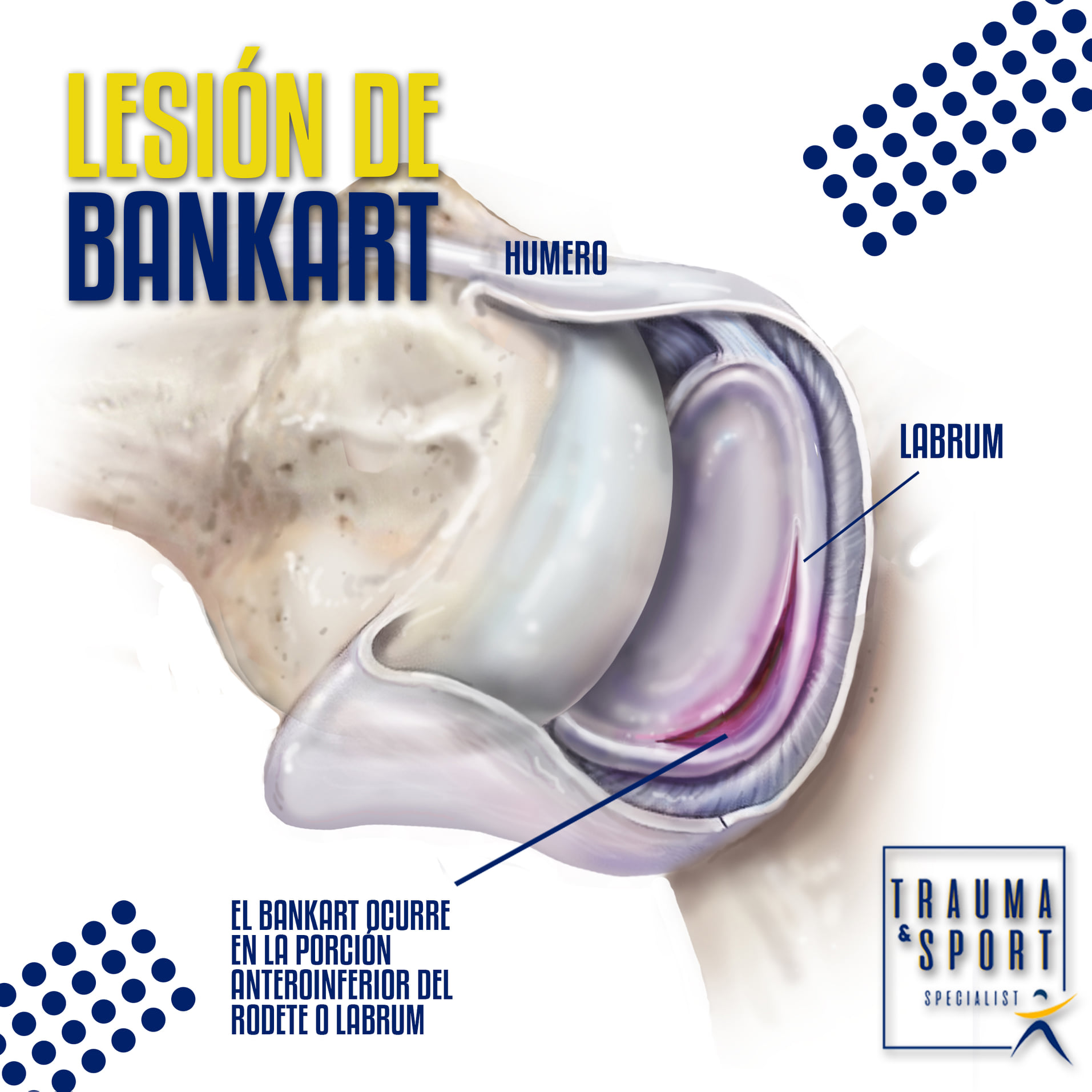 LESIÓN DE BANKART La lesión de Bankart se caracteriza por el ...