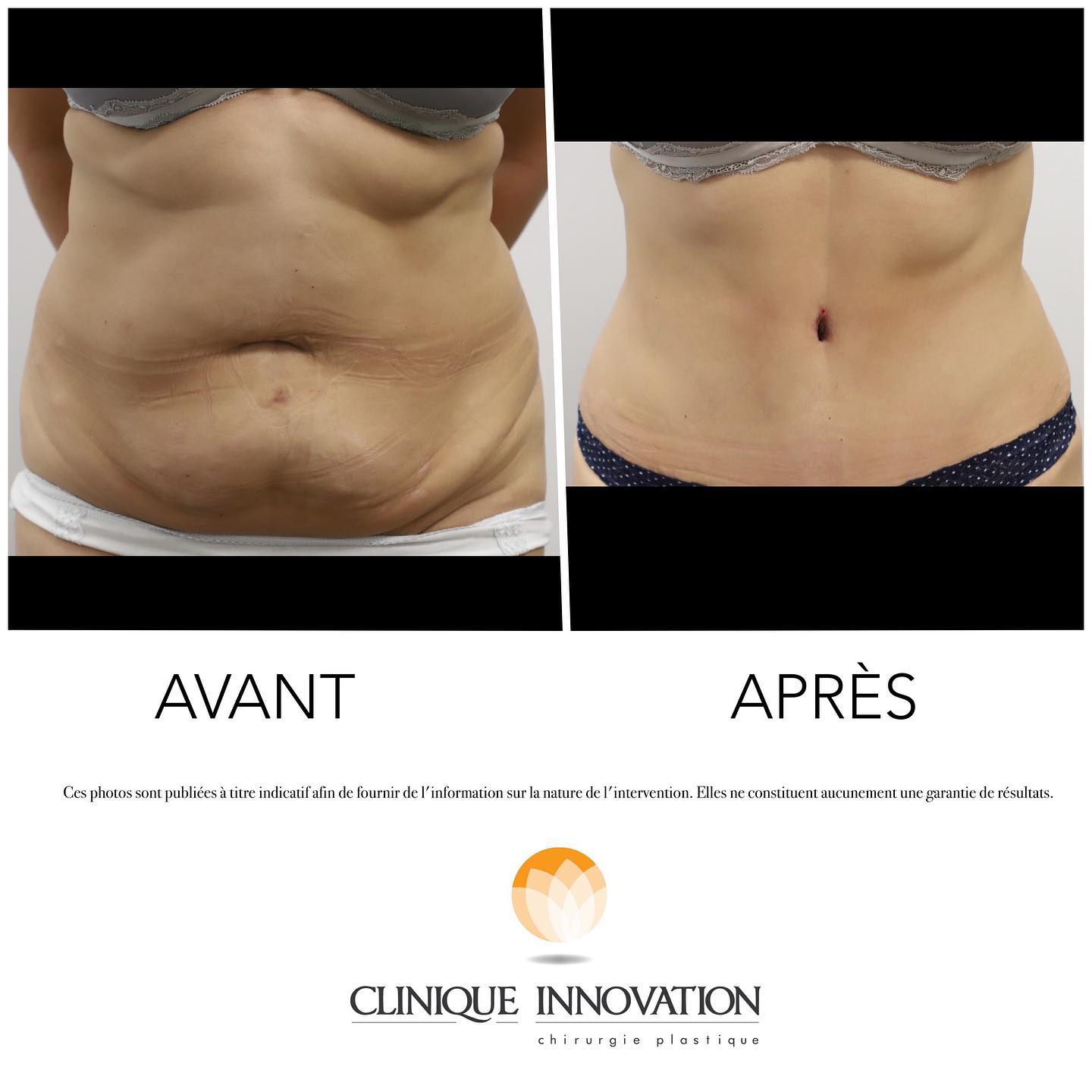Dr - Avant & Après ✨ Abdominoplastie complète avec liposuccion 360 #drmariolucpatient #transformationtuesday #beforeandafter