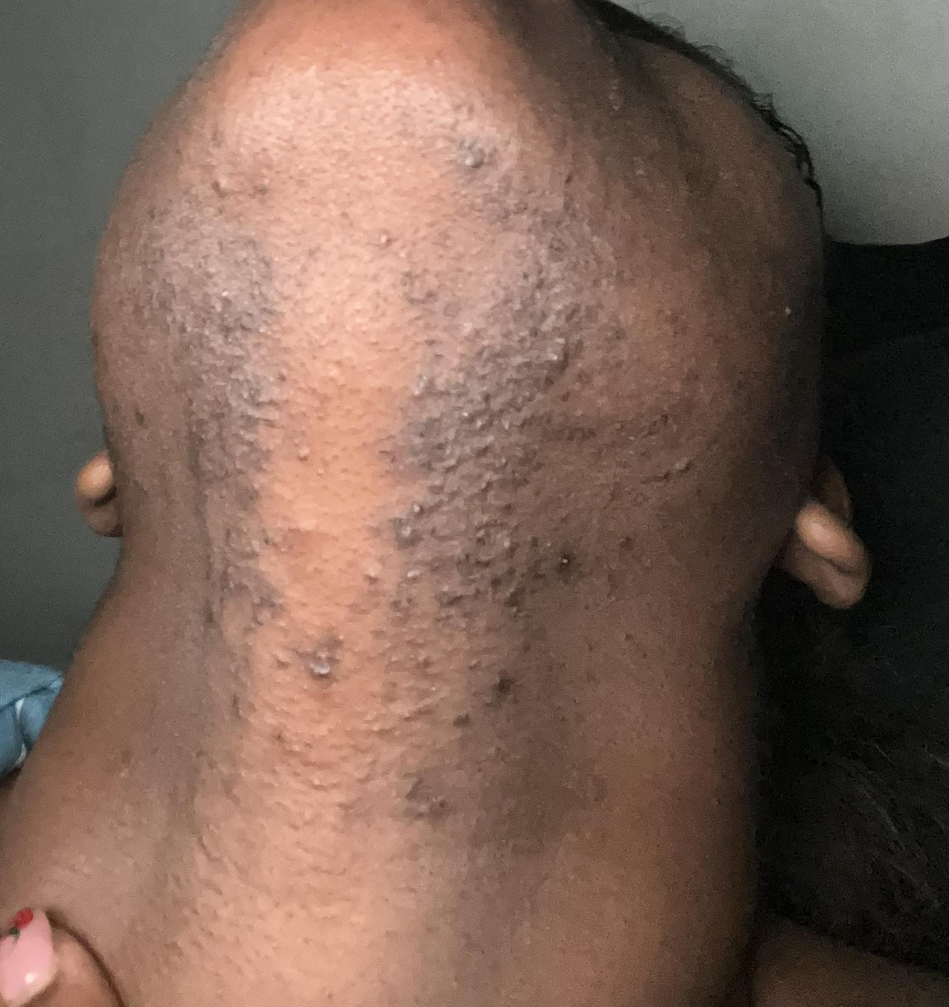 What natural remedies help sensitive skin with lupus?