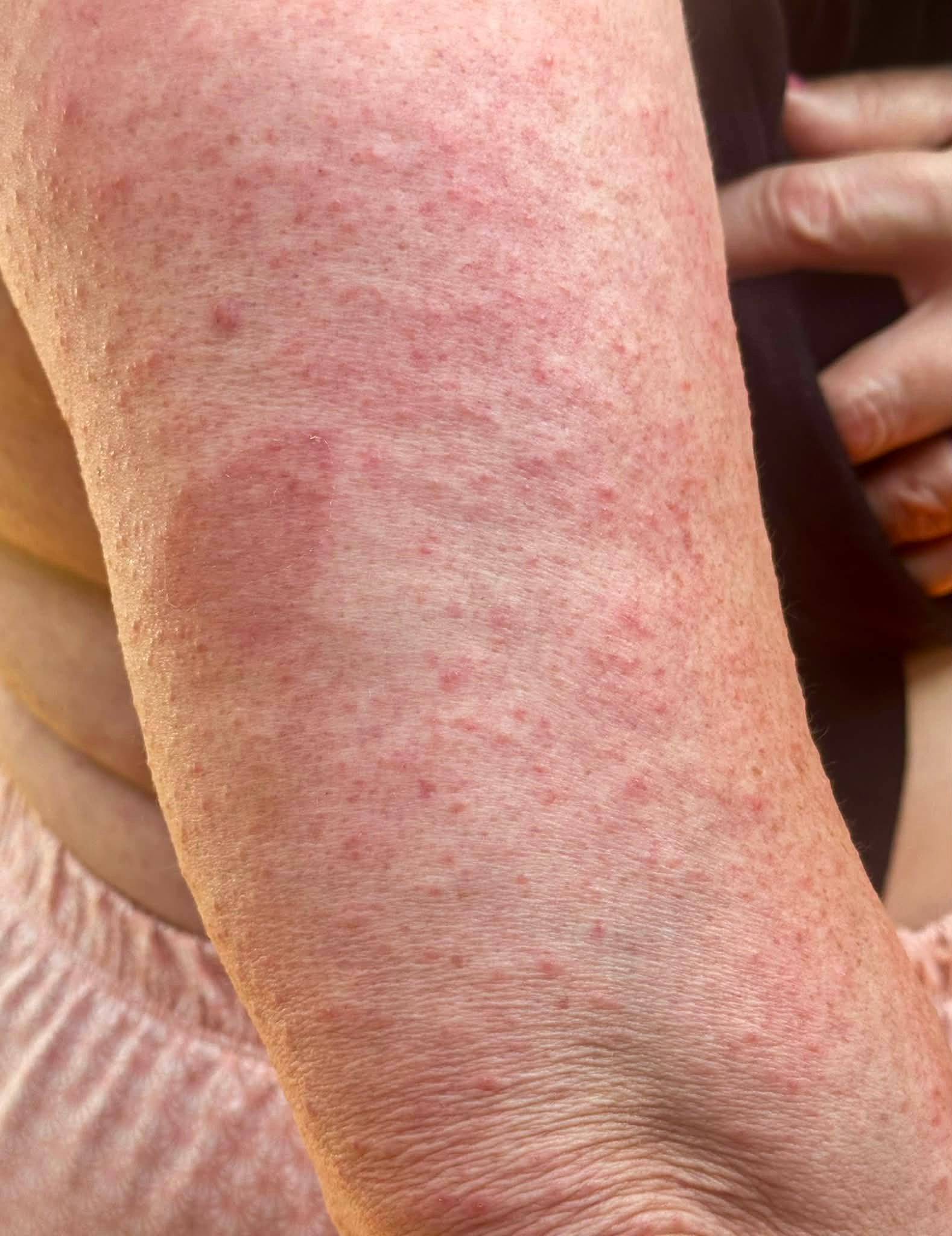 RASH 1mm タッパー　ML Zepbound injection site reaction and rash, tapering and switching