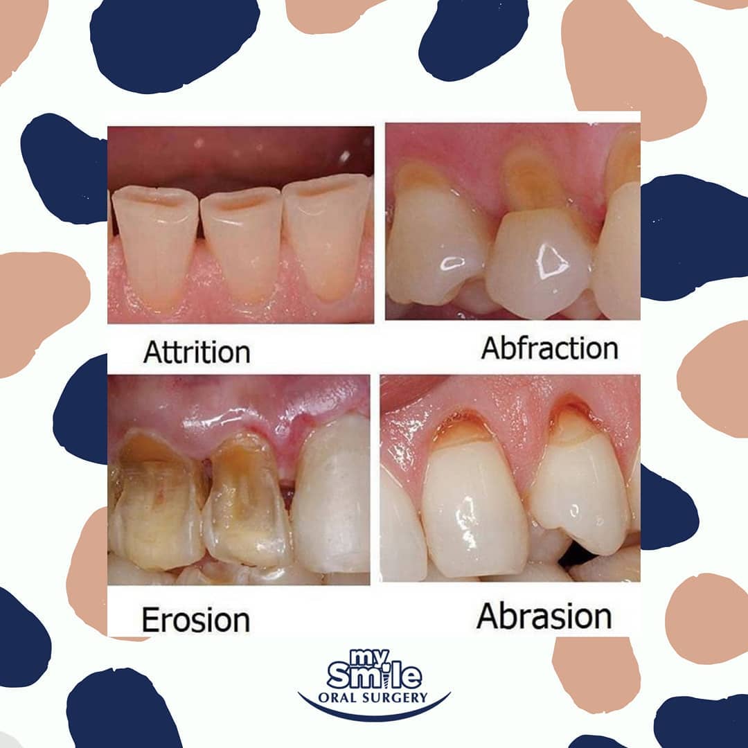 My Smile Oral Surgery - What is the difference between dental Attrition ...