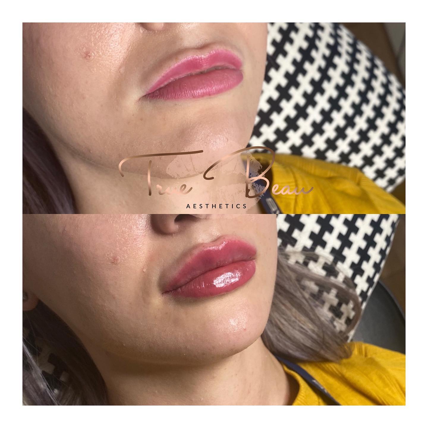 New lips...who dis 🥰 ️💉 1ml... - True Beau Aesthetics