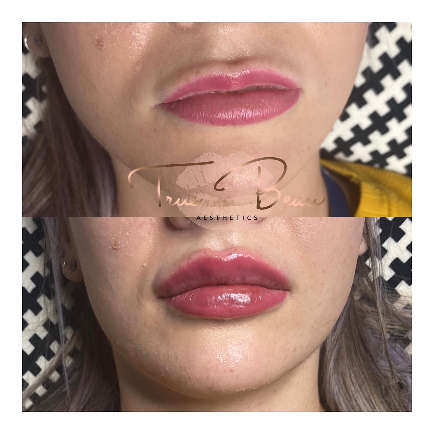 New lips...who dis 🥰 ️💉 1ml... - True Beau Aesthetics