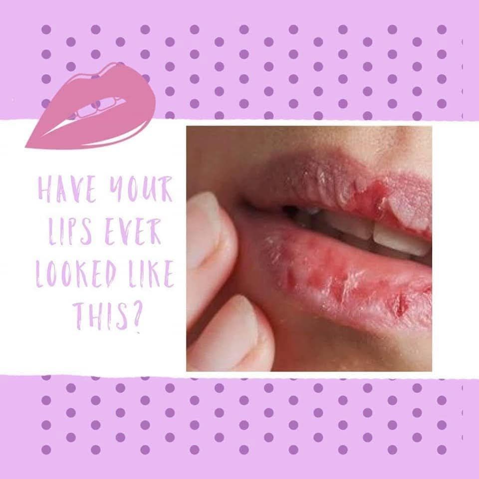 vitamin c deficiency cracked lips can cause dry Dry, cracked, pale or dark sometimes be a sign of Dry Lips Vitamin Deficiency: Nutrient