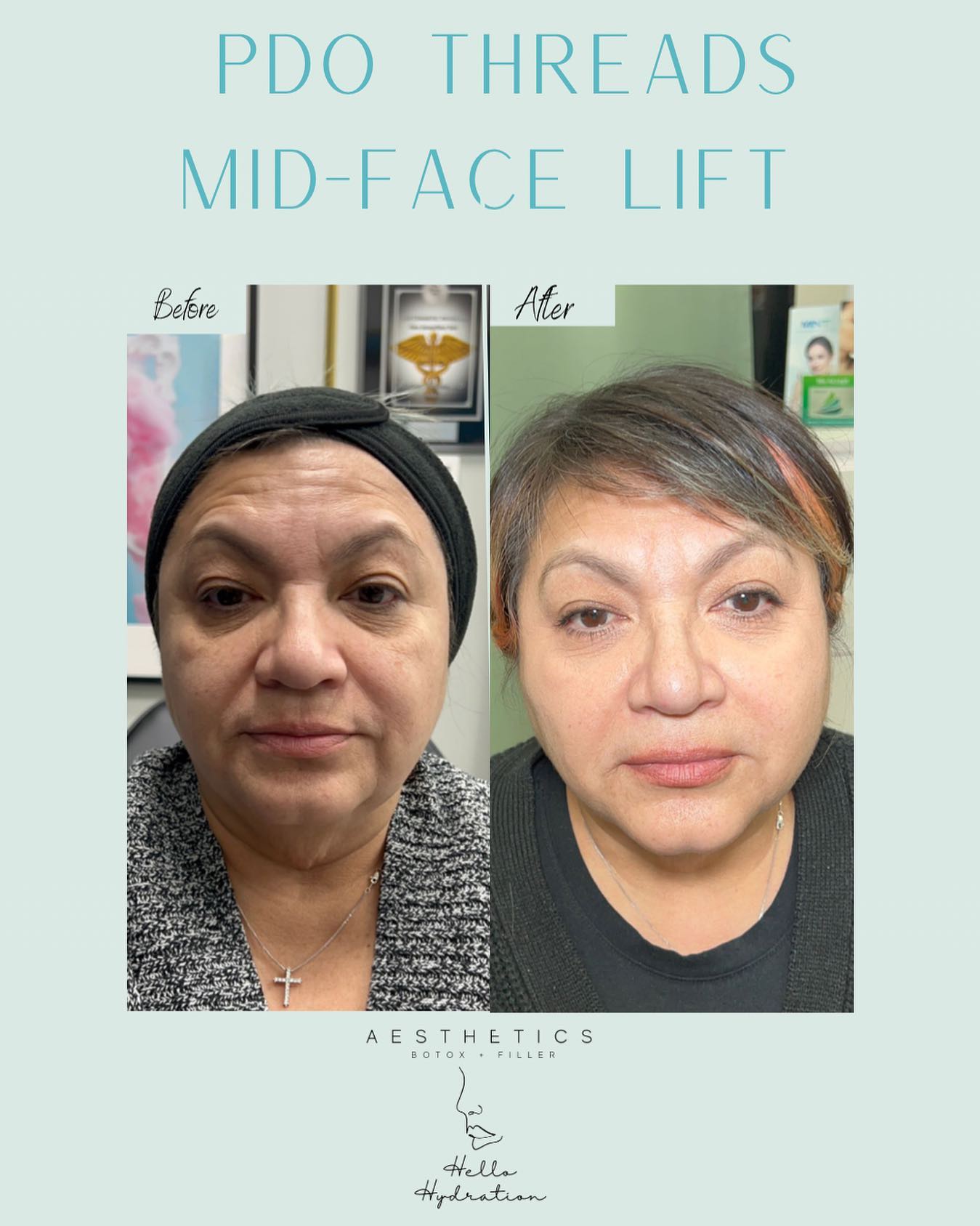 Hello Hydration - Beautiful natural PDO thread lift😍 Mid...