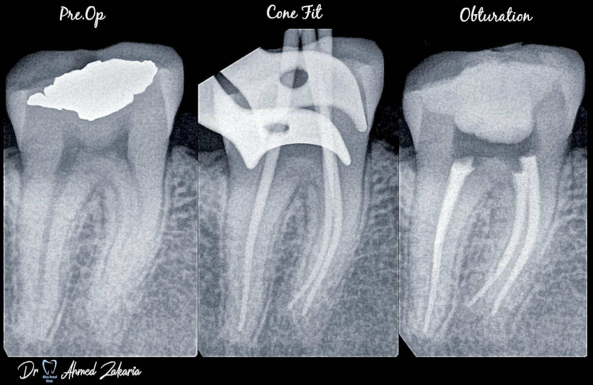 Zerodonto Dentistry | RCT for Curved Lower Second Molar 💯 | Facebook