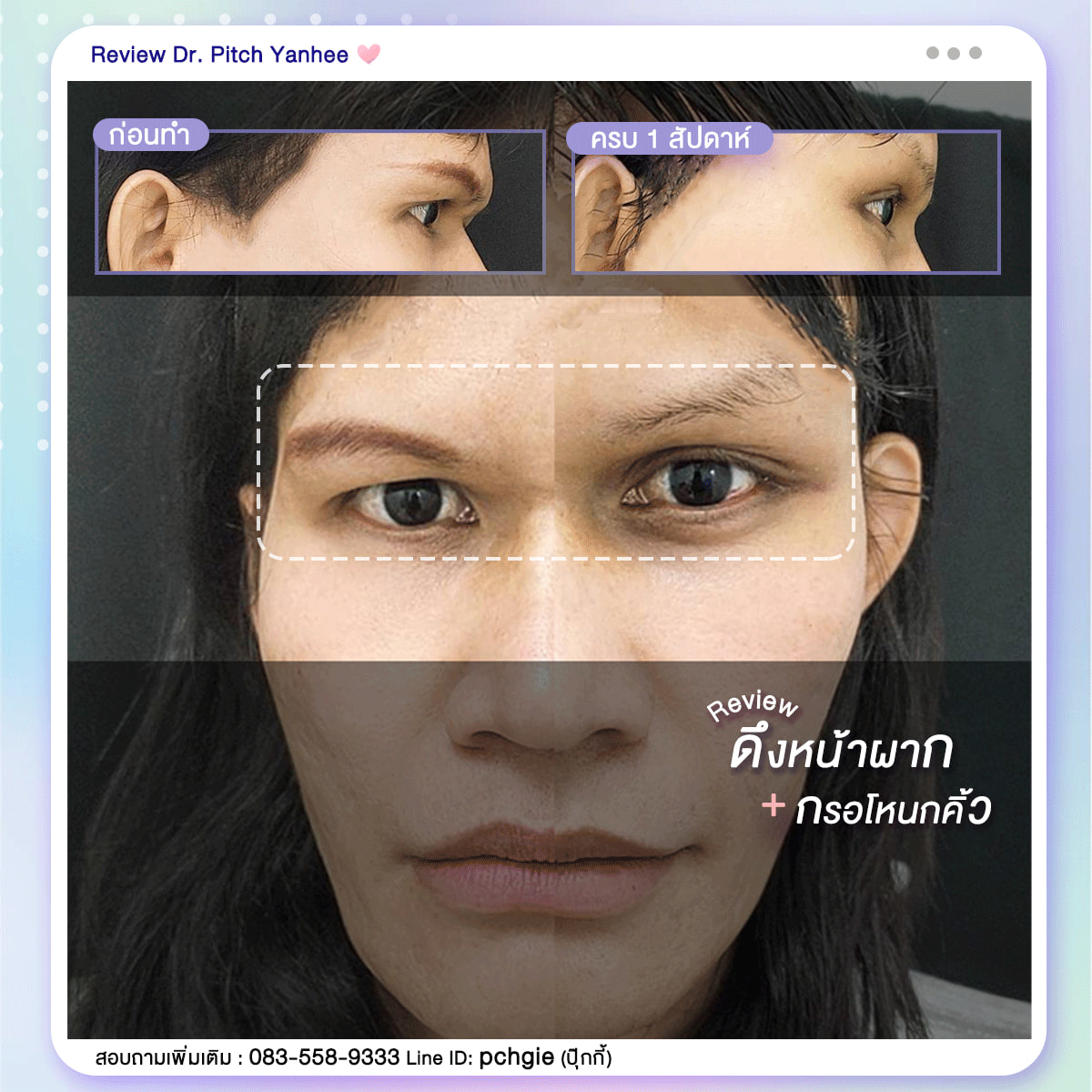 หนุ่มๆ สาวๆ... - ดึงหน้า ตัดไขมันกระชับสัดส่วน หมอพิชญ์ยันฮี