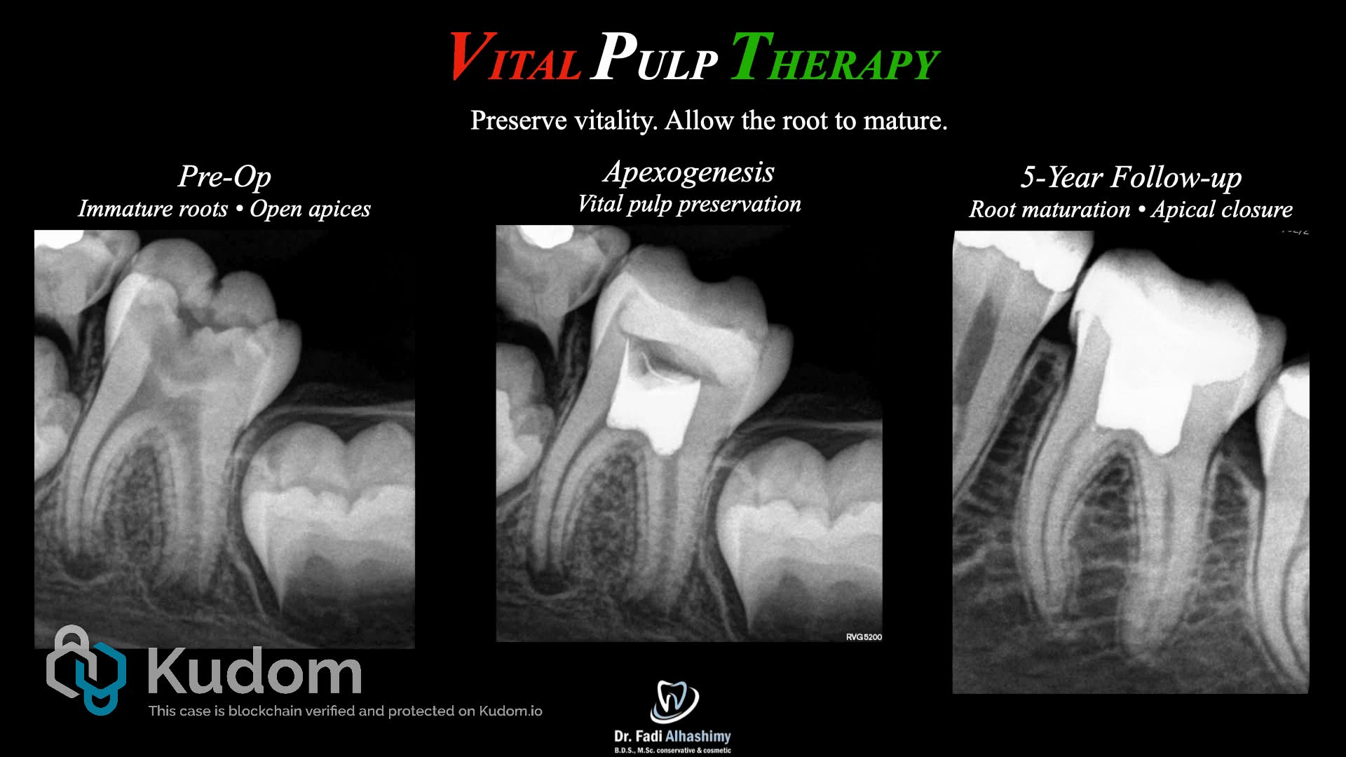 vital pulp therapy，VPT 。 Pulp capping→Kp BP