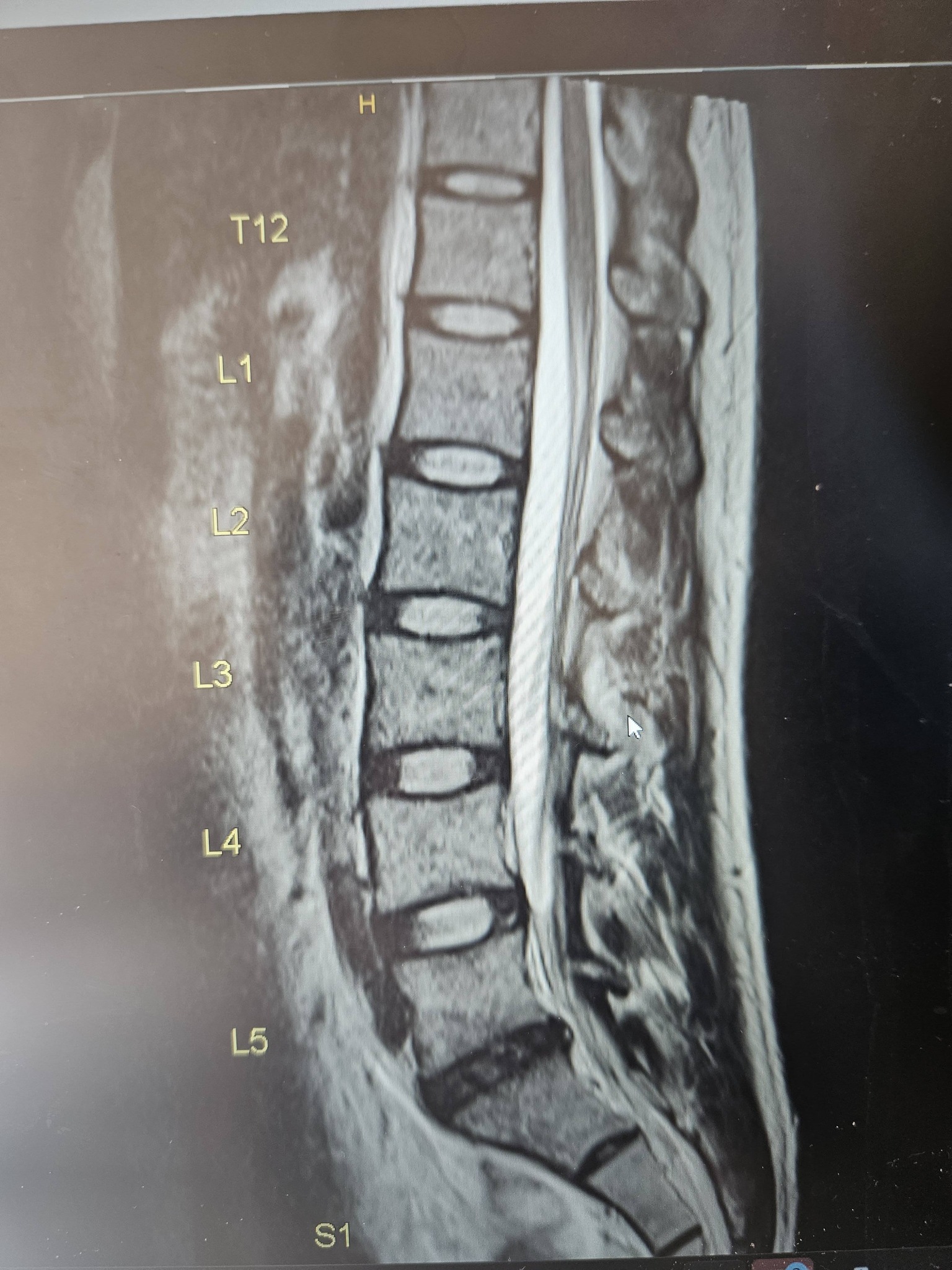 Healing and pain relief for disc bulge l5/s1?