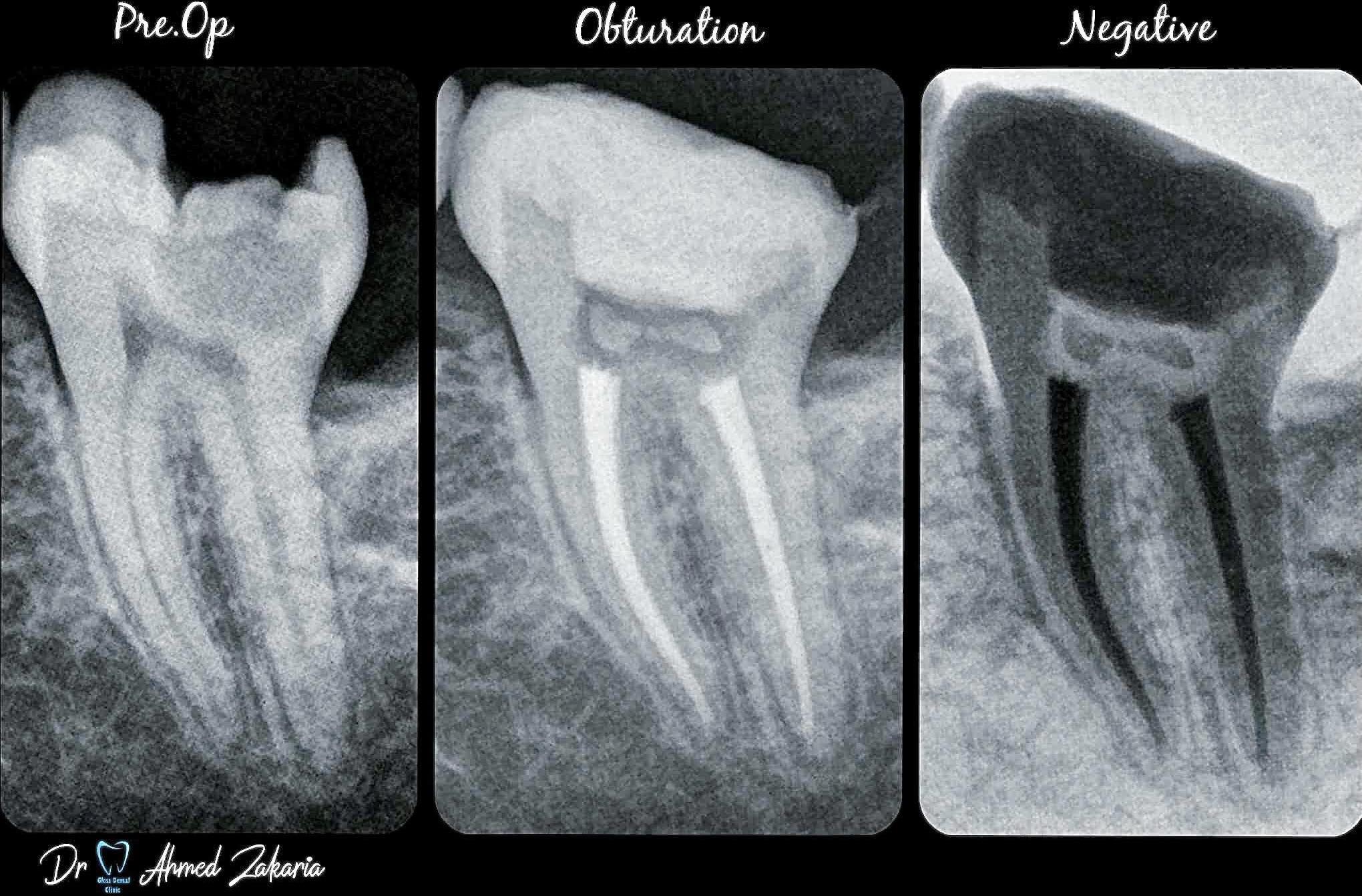 Style Italiano Endodontics | RCT for Curved Lower Second Molar 💯 | Facebook