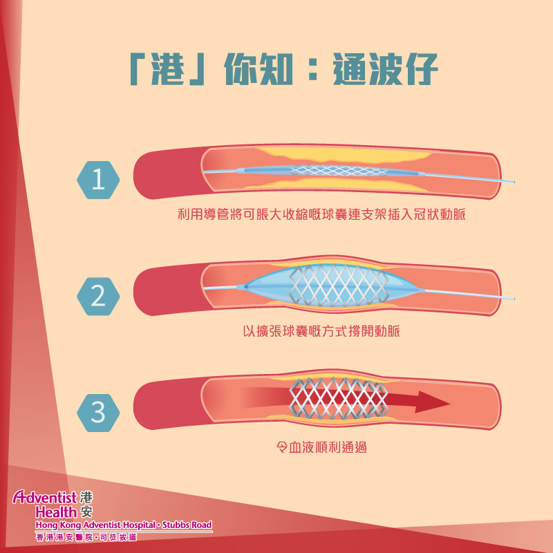 港」你知：通波仔】 成日聽到冠心病病人要進行「通波仔」手術，到底咩係通波仔，又係咪真係有個波仔呢？ 「通波仔」其實係冠狀動脈介入治療嘅俗稱，係 ...