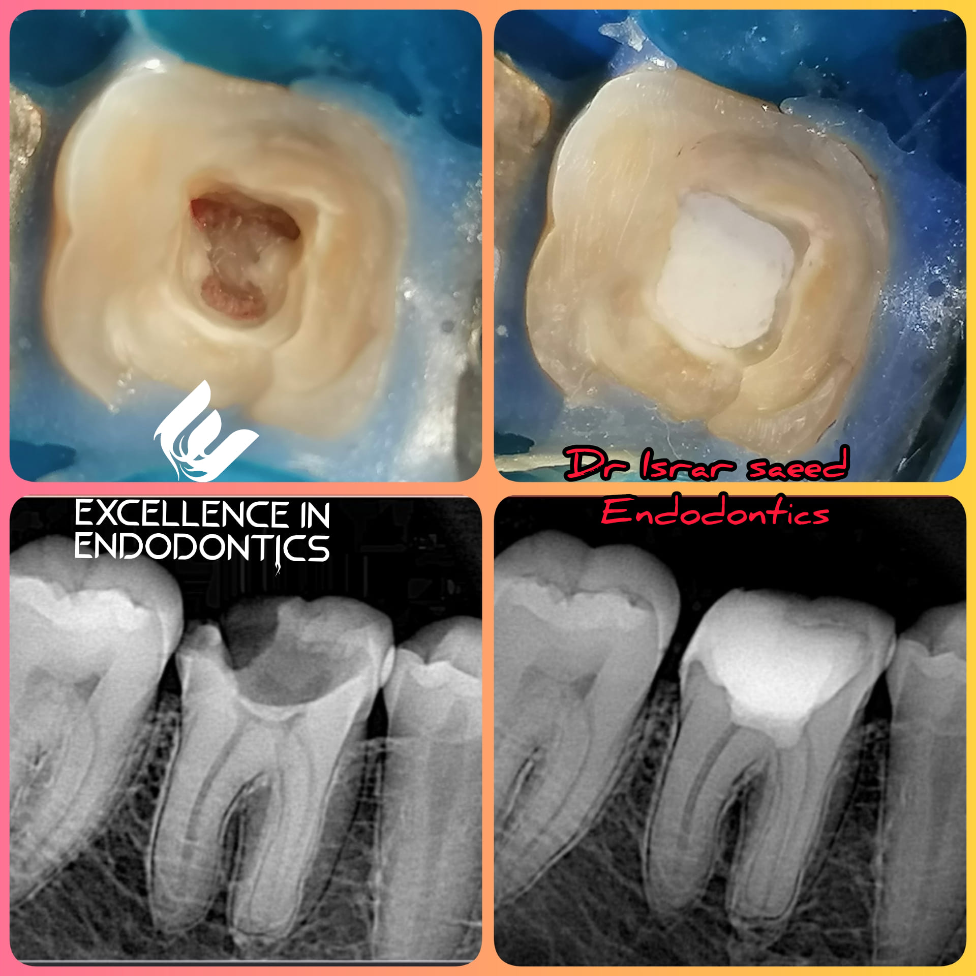 Vital pulp therapy replacing root canal treatment for irreversible