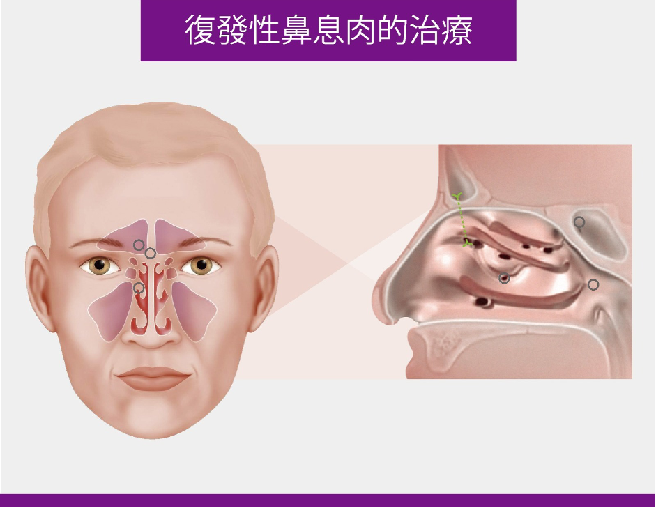 【鼻息肉】病徵及傳統治療法... - Enritech Medical Company Limited