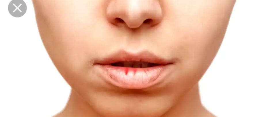 Anyone know if dry, chapped lips can be caused from B vitamin deficiency?