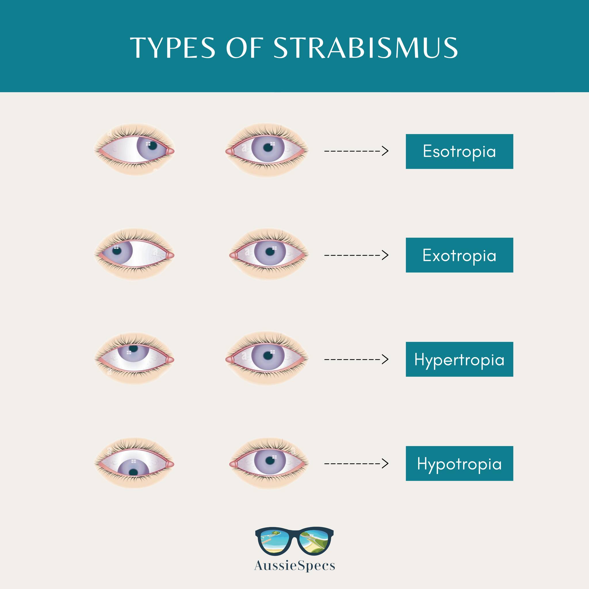 AussieSpecs - 👁️ Strabismus comes in different types, each... | Facebook